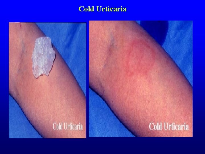 Cold Urticaria 