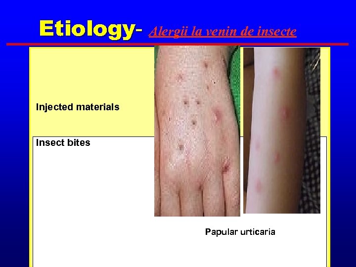 Etiology- Alergii la venin de insecte Injected materials Insect bites Papular urticaria 