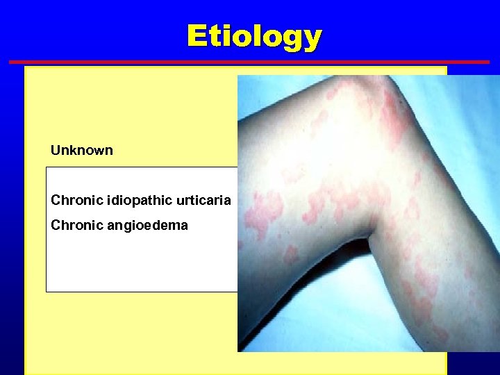 Etiology Unknown Chronic idiopathic urticaria Chronic angioedema 