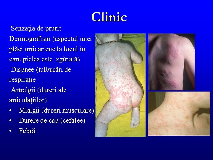 Clinic Senzaţia de prurit Dermografism (aspectul unei plăci urticariene la locul în care pielea