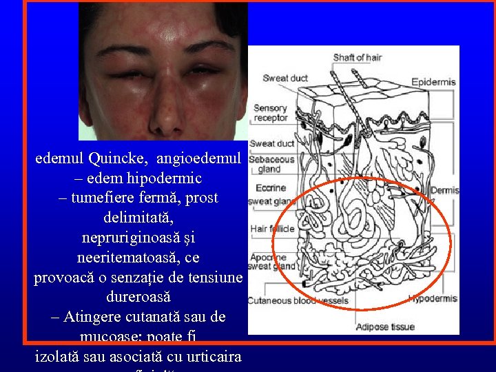 edemul Quincke, angioedemul – edem hipodermic – tumefiere fermă, prost delimitată, nepruriginoasă și neeritematoasă,