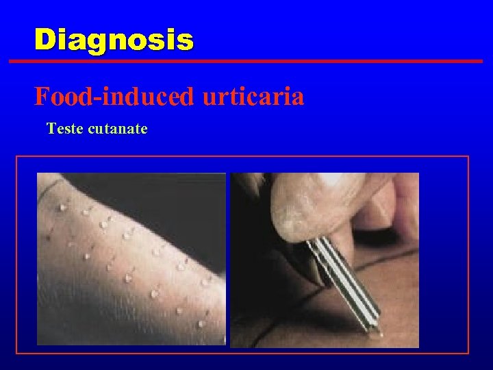 Diagnosis Food-induced urticaria Teste cutanate 