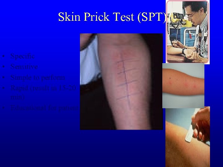 Skin Prick Test (SPT) • • Specific Sensitive Simple to perform Rapid (result in