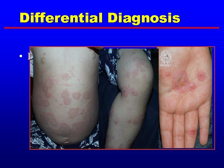Differential Diagnosis • Erythema multiforme, minor 