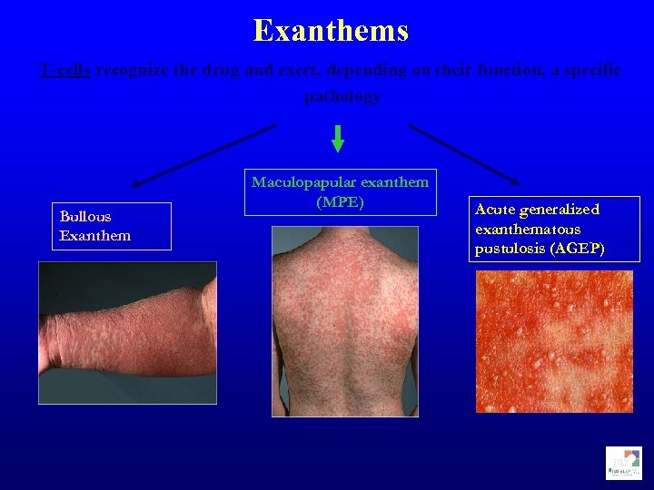 Exanthems T-cells recognize the drug and exert, depending on their function, a specific pathology