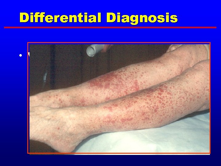 Differential Diagnosis • Vasculitis 