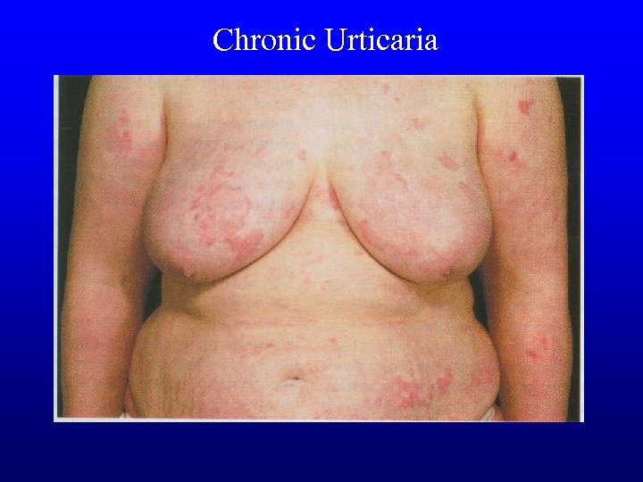  Chronic Urticaria 