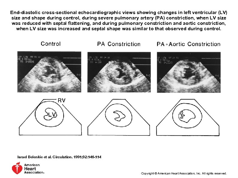 End-diastolic cross-sectional echocardiographic views showing changes in left ventricular (LV) size and shape during