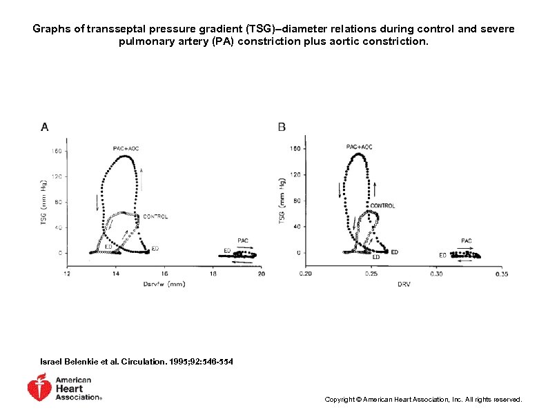 Graphs of transseptal pressure gradient (TSG)–diameter relations during control and severe pulmonary artery (PA)