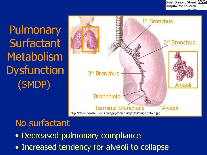 Pulmonary Surfactant Metabolism Dysfunction 1° Bronchus 2° Bronchus 3° Bronchus (SMDP) Alveoli Bronchiole Terminal