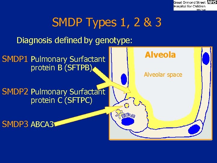 SMDP Types 1, 2 & 3 Diagnosis defined by genotype: SMDP 1 Pulmonary Surfactant