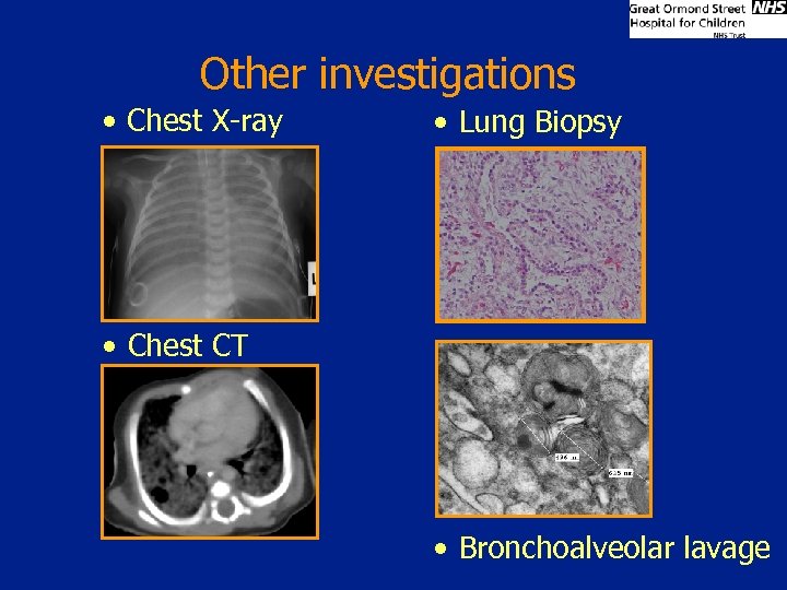 Other investigations • Chest X-ray • Lung Biopsy • Chest CT • Bronchoalveolar lavage