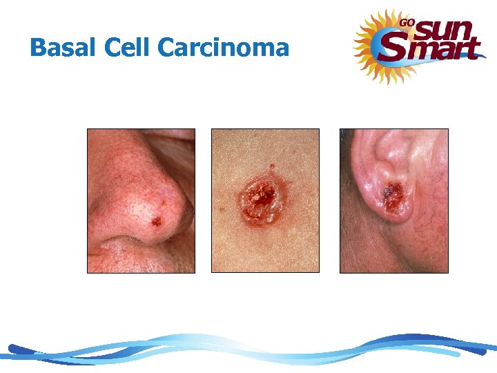 Basal Cell Carcinoma BBasbasal Cell Carcinoma 