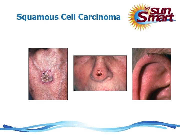 Squamous Cell Carcinoma 