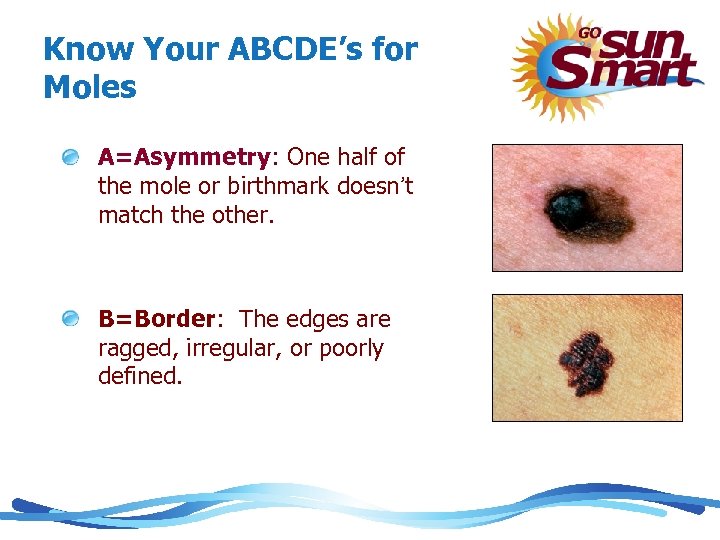 Know Your ABCDE’s for Moles A=Asymmetry: One half of the mole or birthmark doesn’t