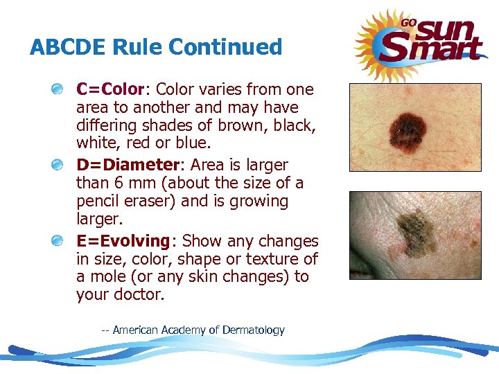 ABCDE Rule Continued C=Color: Color varies from one area to another and may have