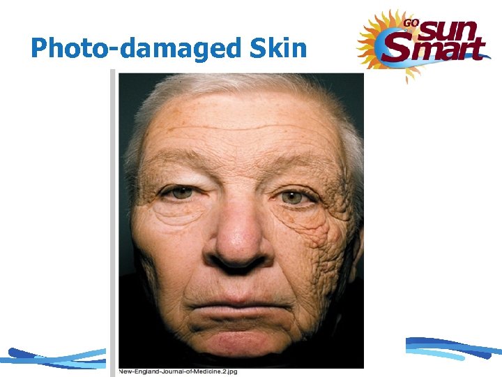 Photo-damaged Skin 