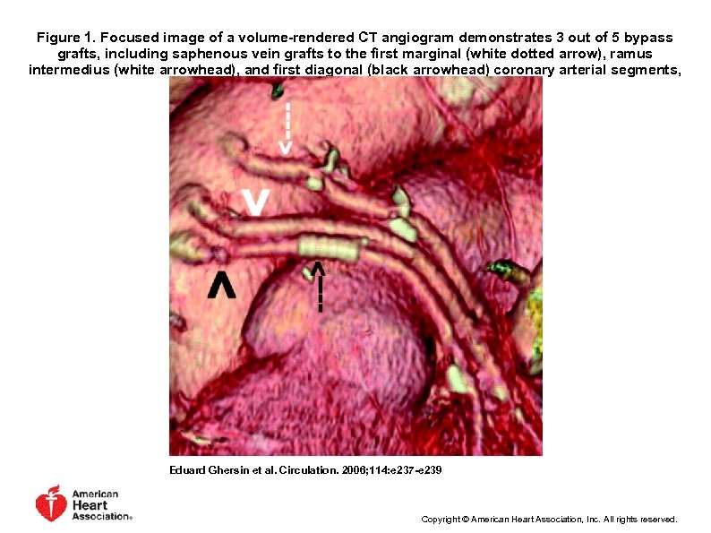 Figure 1. Focused image of a volume-rendered CT angiogram demonstrates 3 out of 5