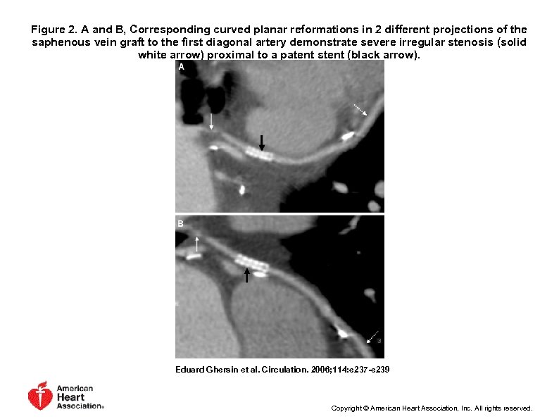 Figure 2. A and B, Corresponding curved planar reformations in 2 different projections of
