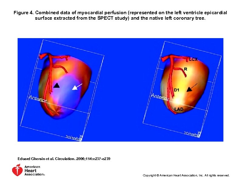 Figure 4. Combined data of myocardial perfusion (represented on the left ventricle epicardial surface