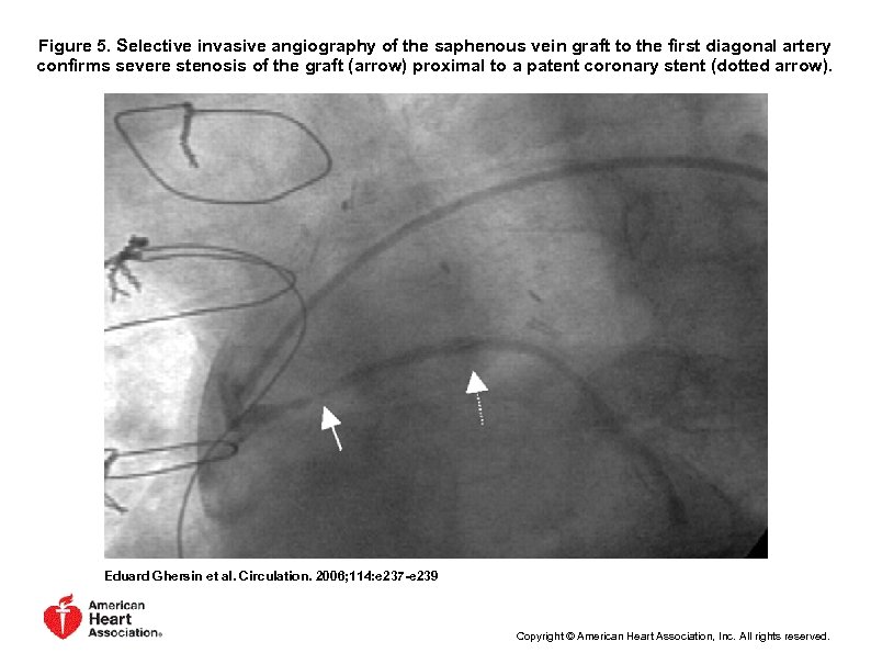 Figure 5. Selective invasive angiography of the saphenous vein graft to the first diagonal