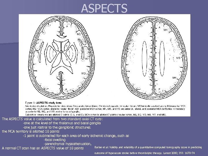 ASPECTS The ASPECTS value is calculated from two standard axial CT cuts: -one at