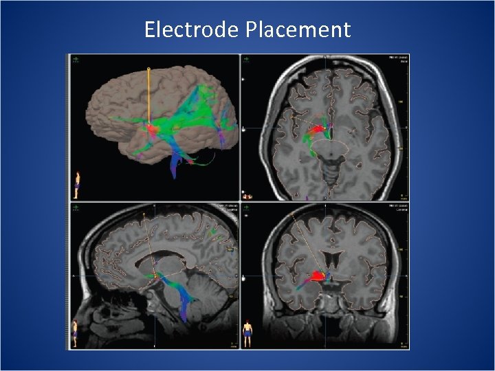 Electrode Placement 