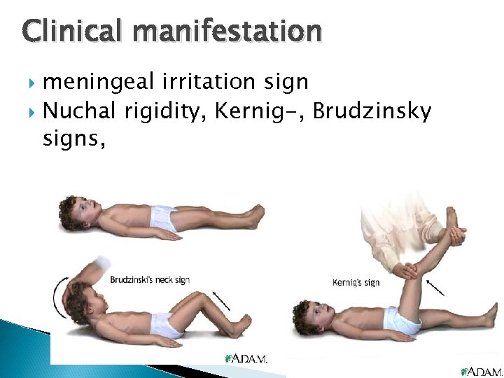 Clinical manifestation meningeal irritation sign Nuchal rigidity, Kernig-, Brudzinsky signs, 