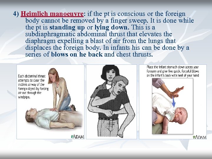 4) Heimlich manoeuvre: if the pt is conscious or the foreign body cannot be