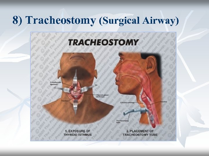 8) Tracheostomy (Surgical Airway) 