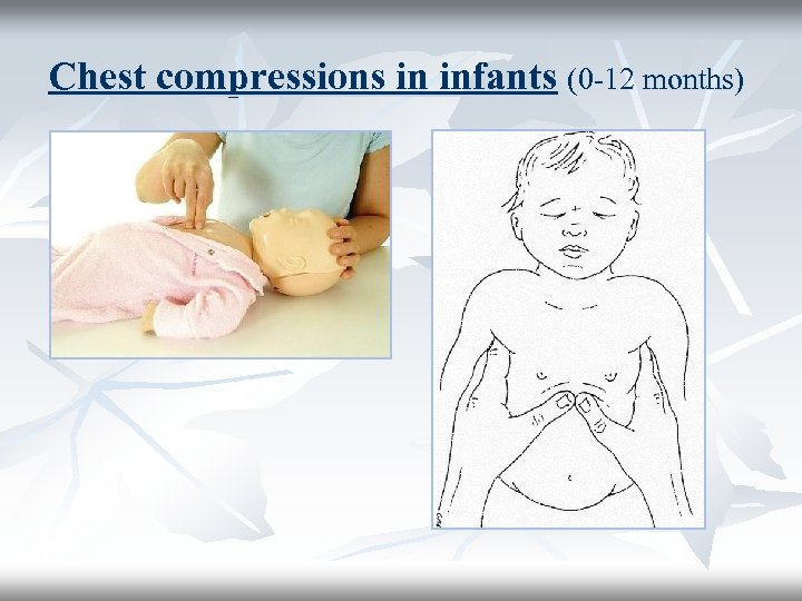 Chest compressions in infants (0 -12 months) 