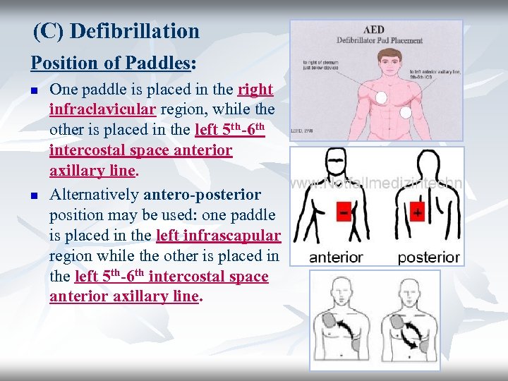(C) Defibrillation Position of Paddles: n n One paddle is placed in the right