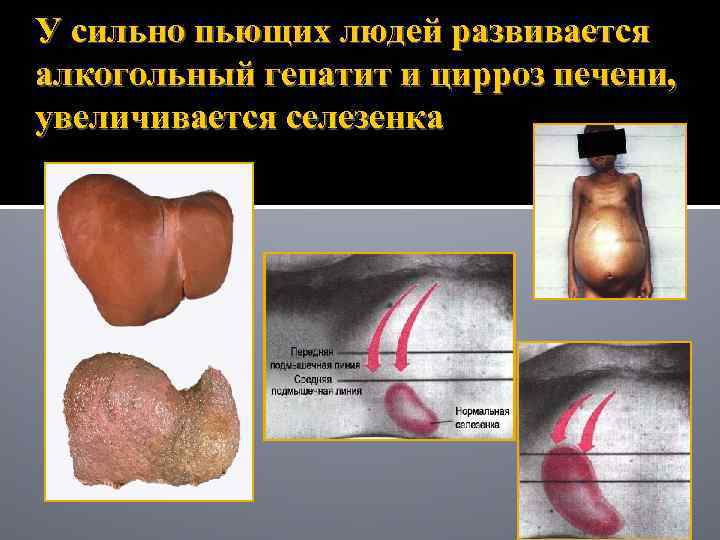 У сильно пьющих людей развивается алкогольный гепатит и цирроз печени, увеличивается селезенка 