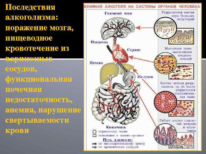 Последствия алкоголизма: поражение мозга, пищеводное кровотечение из варикозных сосудов, функциональная почечная недостаточность, анемия, нарушение