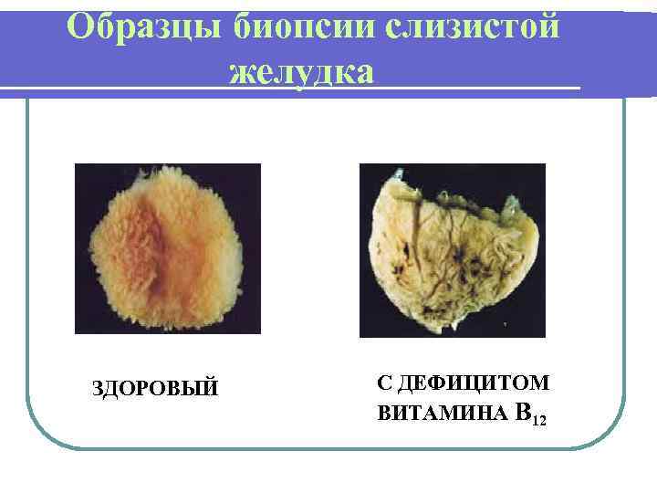 Образцы биопсии слизистой желудка ЗДОРОВЫЙ С ДЕФИЦИТОМ ВИТАМИНА В 12 