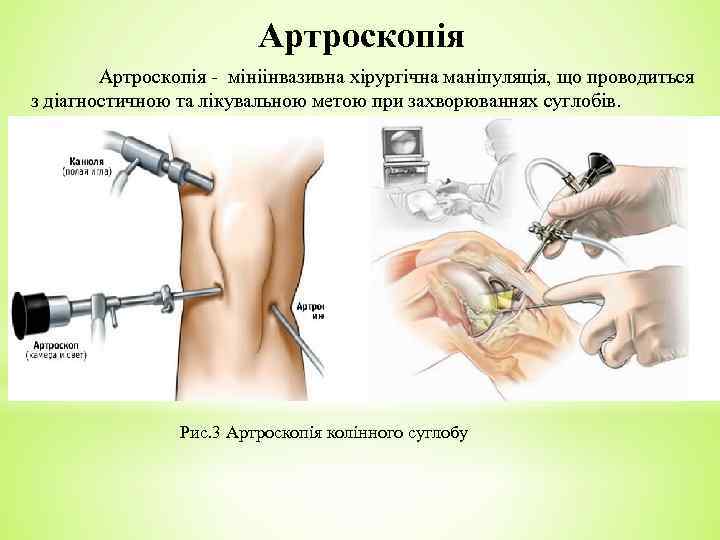 Артроскопія - мініінвазивна хірургічна маніпуляція, що проводиться з діагностичною та лікувальною метою при захворюваннях