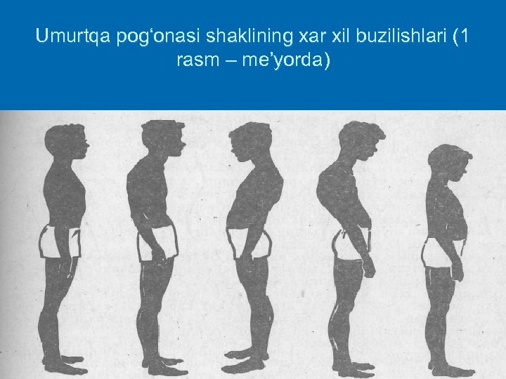 Umurtqa pog‘onasi shaklining xar xil buzilishlari (1 rasm – me’yorda) 