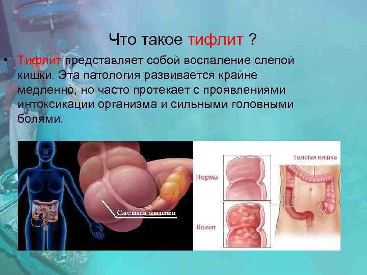 Что такое тифлит ? • Тифлит представляет собой воспаление слепой кишки. Эта патология развивается