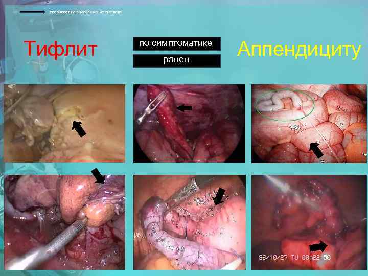 -Указывает на расположение тифлита Тифлит по симптоматике равен Аппендициту 