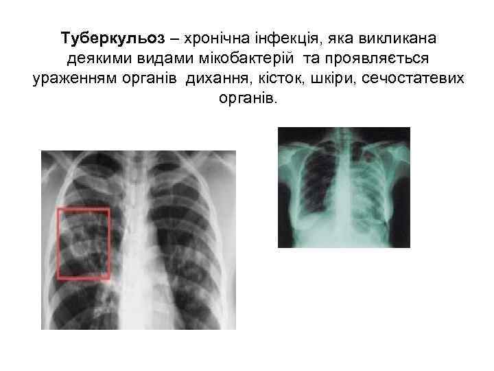 Туберкульоз – хронічна інфекція, яка викликана деякими видами мікобактерій та проявляється ураженням органів дихання,