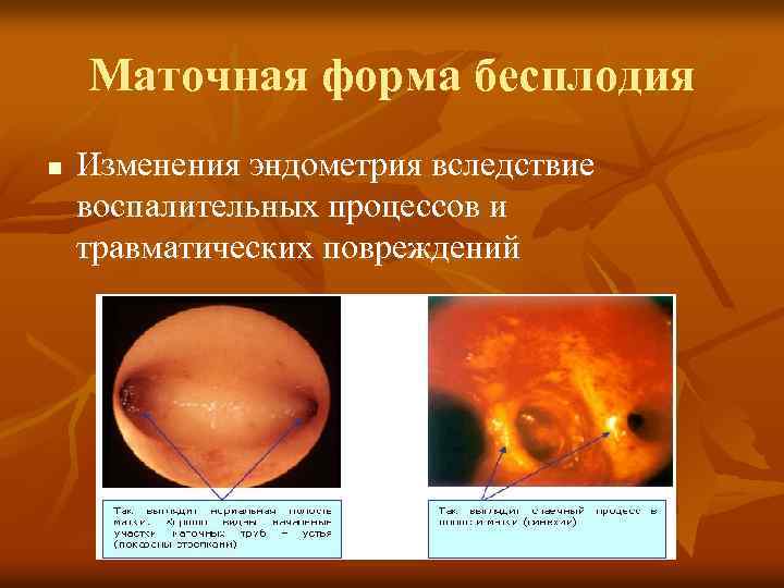 Маточная форма бесплодия n Изменения эндометрия вследствие воспалительных процессов и травматических повреждений 