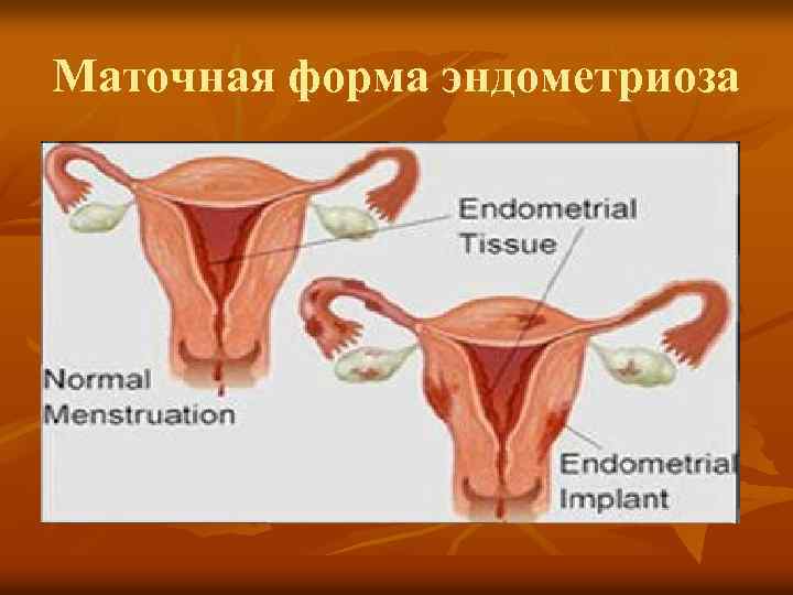 Маточная форма эндометриоза 