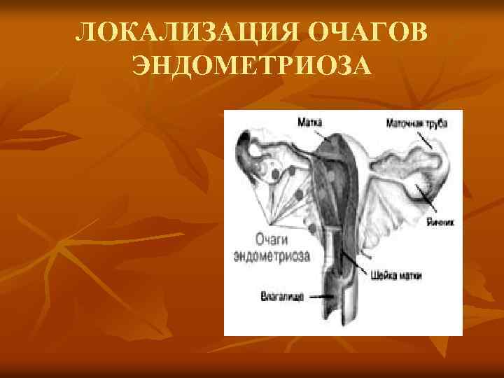 ЛОКАЛИЗАЦИЯ ОЧАГОВ ЭНДОМЕТРИОЗА 