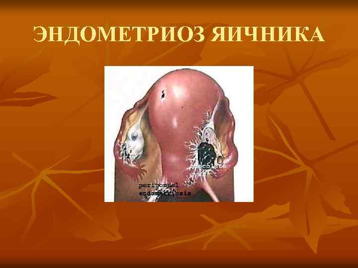 ЭНДОМЕТРИОЗ ЯИЧНИКА 