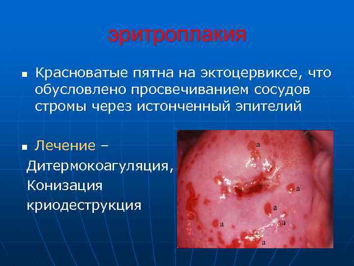 эритроплакия n Красноватые пятна на эктоцервиксе, что обусловлено просвечиванием сосудов стромы через истонченный эпителий