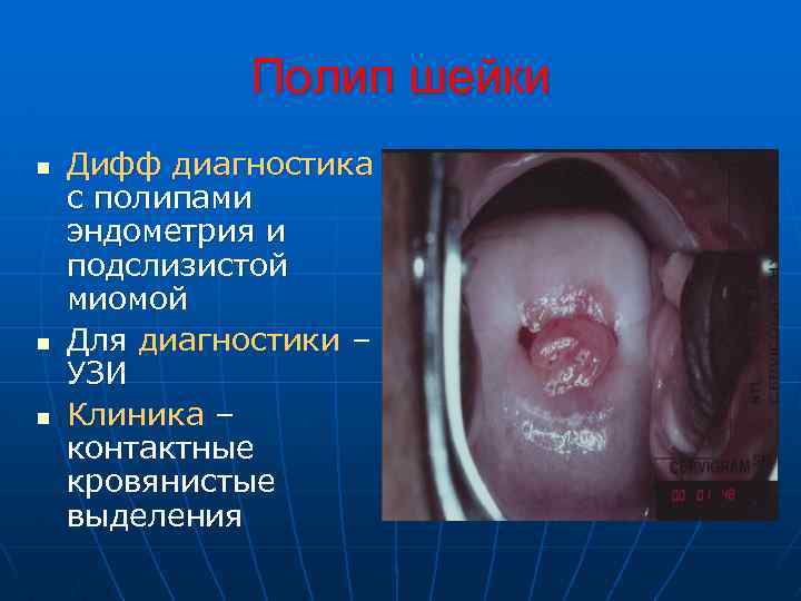 Полип шейки n n n Дифф диагностика с полипами эндометрия и подслизистой миомой Для