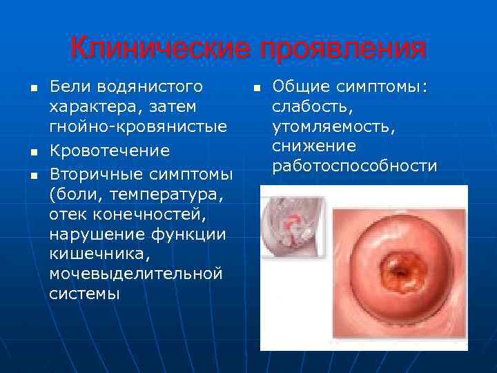 Клинические проявления n n n Бели водянистого характера, затем гнойно-кровянистые Кровотечение Вторичные симптомы (боли,