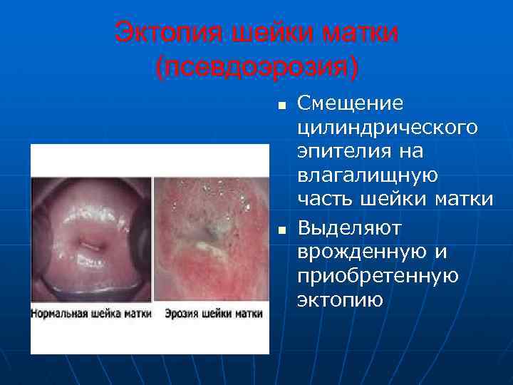 Эктопия шейки матки (псевдоэрозия) n n Смещение цилиндрического эпителия на влагалищную часть шейки матки