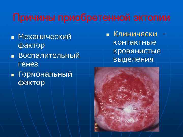 Причины приобретенной эктопии n n n Механический фактор Воспалительный генез Гормональный фактор n Клинически