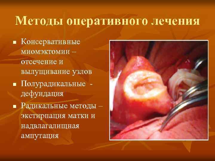 Методы оперативного лечения n n n Консервативные миомэктомии – отсечение и вылущивание узлов Полурадикальные